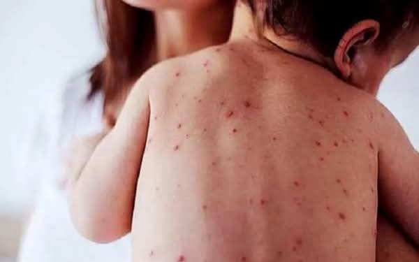 Fallece bebé de un año y un mes de edad por complicaciones de sarampión en Tlaxcala; no estaba&nbsp;vacunado